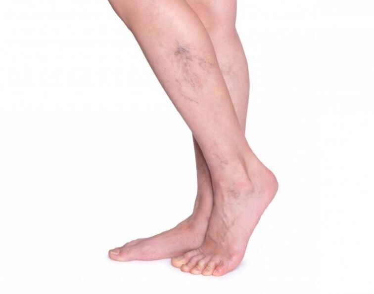 VariForce varicose veins before treatment