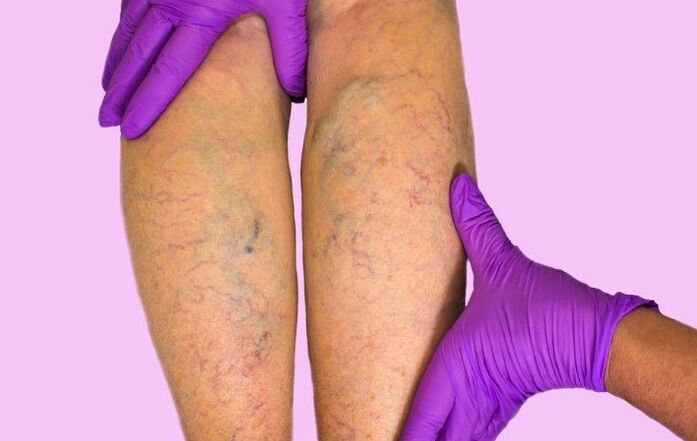 Varicose veins of the lower extremities